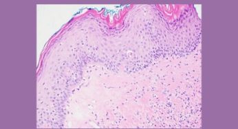 What You Need to Know about Biopsies and Lichen Sclerosus