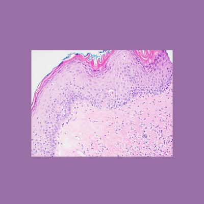 Image of a lichen sclerosus biopsy sample taken at a microscopic level. The tissue is represented by pale pink with dots of purple in varying density. Along the top edge are darker pink finger-like ridges. The image is surrounded by a medium-thickness purple border. The image represents the four key features of LS that pathologists look for: loss of rete ridges, the thickened band of collagen, lack of normal, healthy cells, hyperkeratosis, etc.