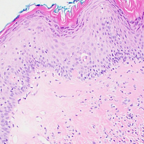Image of a lichen sclerosus biopsy sample taken at a microscopic level. The tissue is represented by pale pink with dots of purple in varying density. Along the top edge are darker pink finger-like ridges. The image represents the four key features of LS that pathologists look for: loss of rete ridges, the thickened band of collagen, lack of normal, healthy cells, hyperkeratosis, etc.