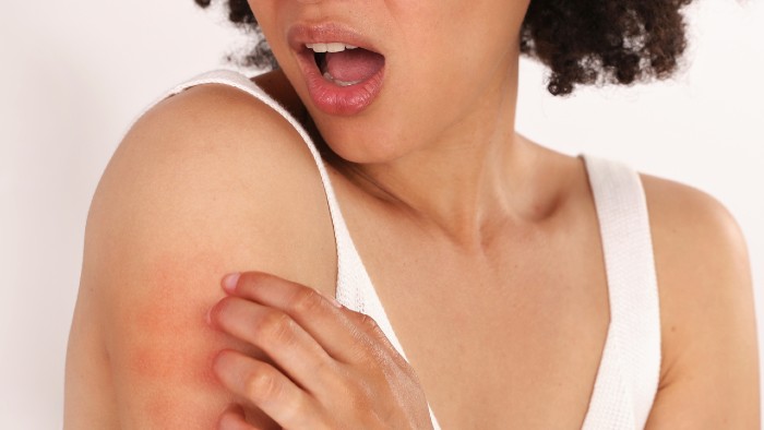 Image of a person with a patch of irritated skin on their arm. While it's not their vulva, this image represents the kind of irritation that can occur from an allergic reaction or contact dermatitis.